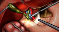 La cirugía con el uso de un laparoscopio es la manera más común de extirpar la vesícula biliar. Un laparoscopio es un tubo delgado e iluminado que le permite al médico ver el interior del abdomen.