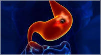 La gastritis o gastroenteritis es un mal que afecta a directamente a las paredes del estómago, provocando una inflamación severa en la mayoría de los casos. El revestimiento gástrico también puede sufrir irritación o incluso hemorragias, lo que puede prov